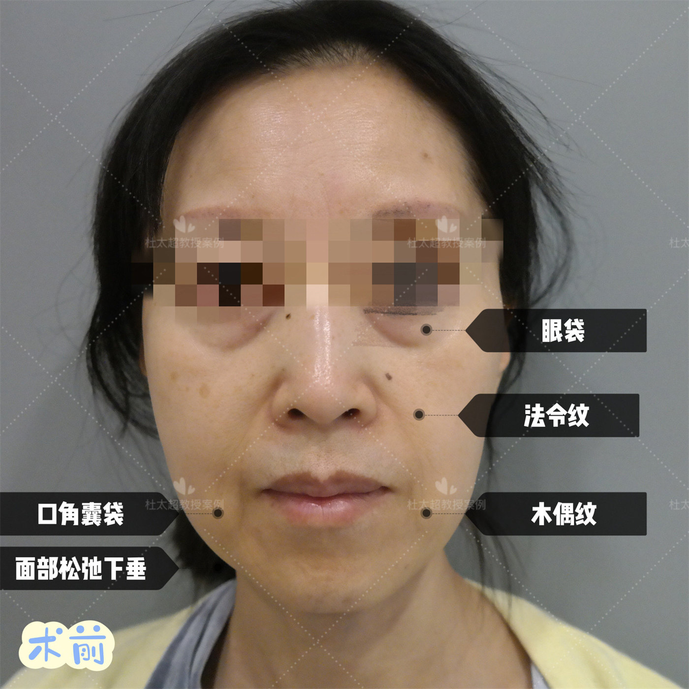 近日有很多粉丝留言问我：“做一次拉皮多少钱？”