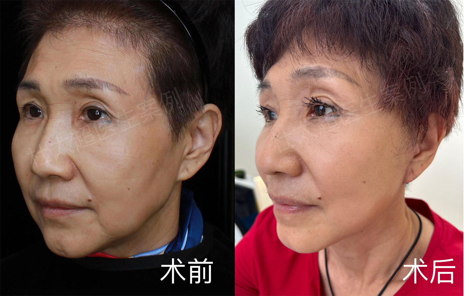 拉皮效果太好了，4个月后又做了去眼袋和眼皮提升，太赞了！