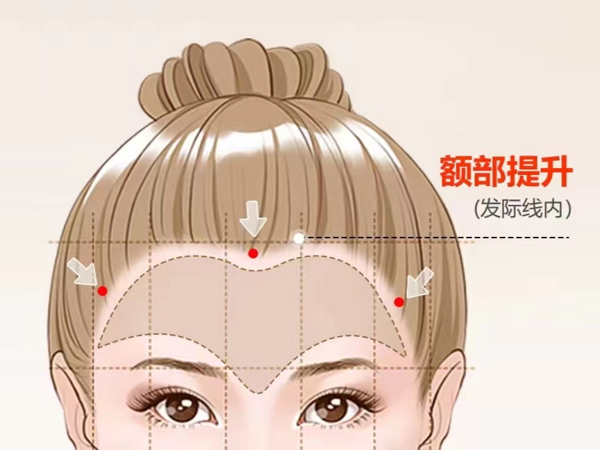 川字纹如何消除？