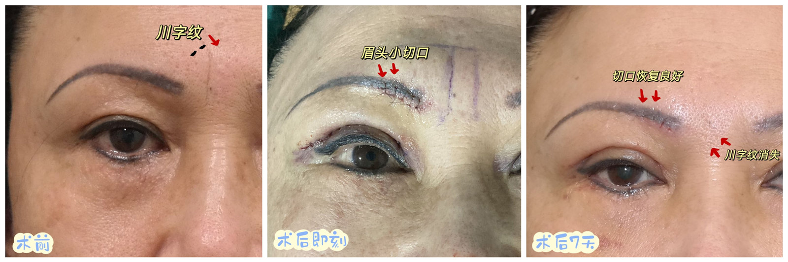 川字纹如何消除？