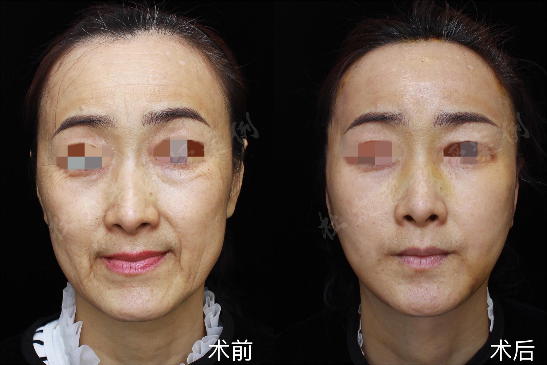 在拉皮手术成功的第七天，我感到心中充满了欢欣，仿佛一切都如意如梦！