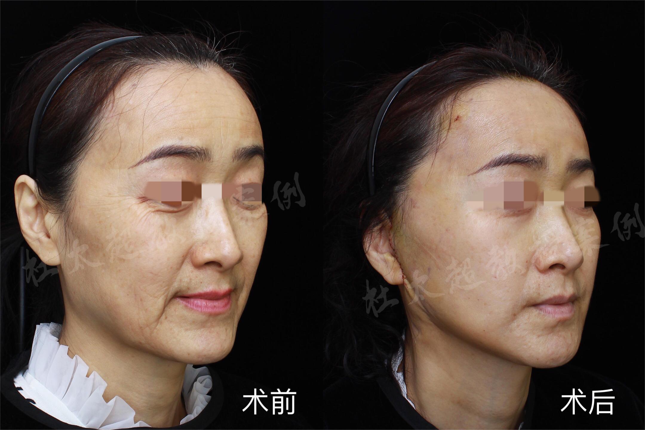 在拉皮手术成功的第七天，我感到心中充满了欢欣，仿佛一切都如意如梦！