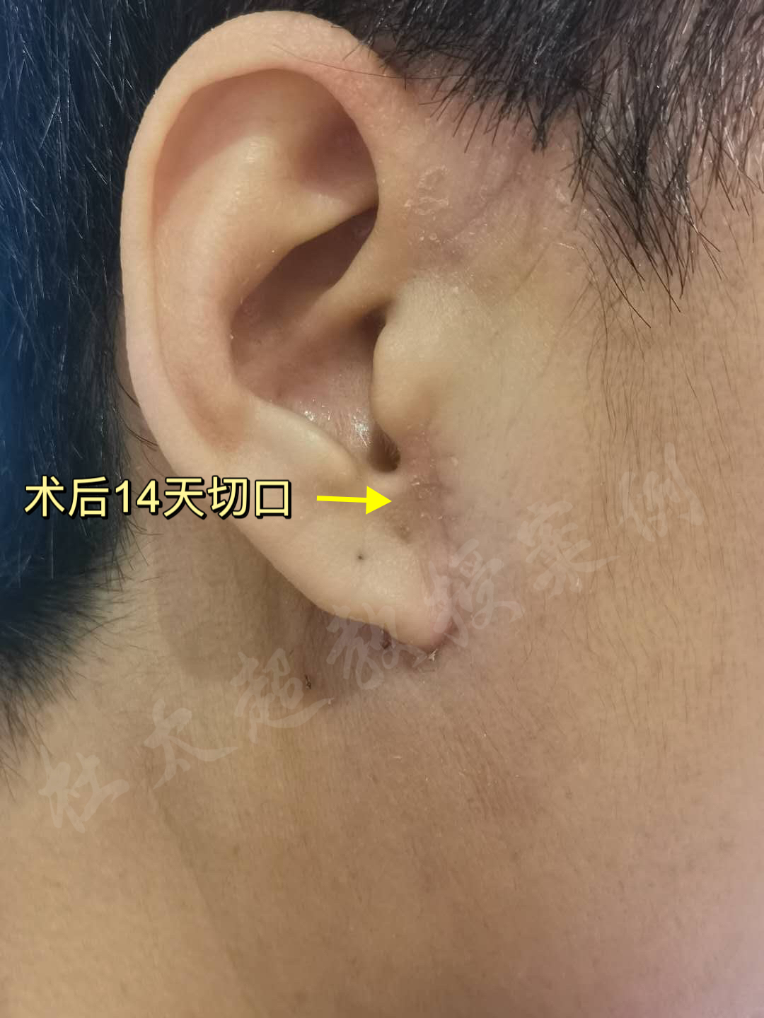 迈过50岁笔直大关的我：如何借由杜太超教授的专业技术，成功挽回落寞青春！