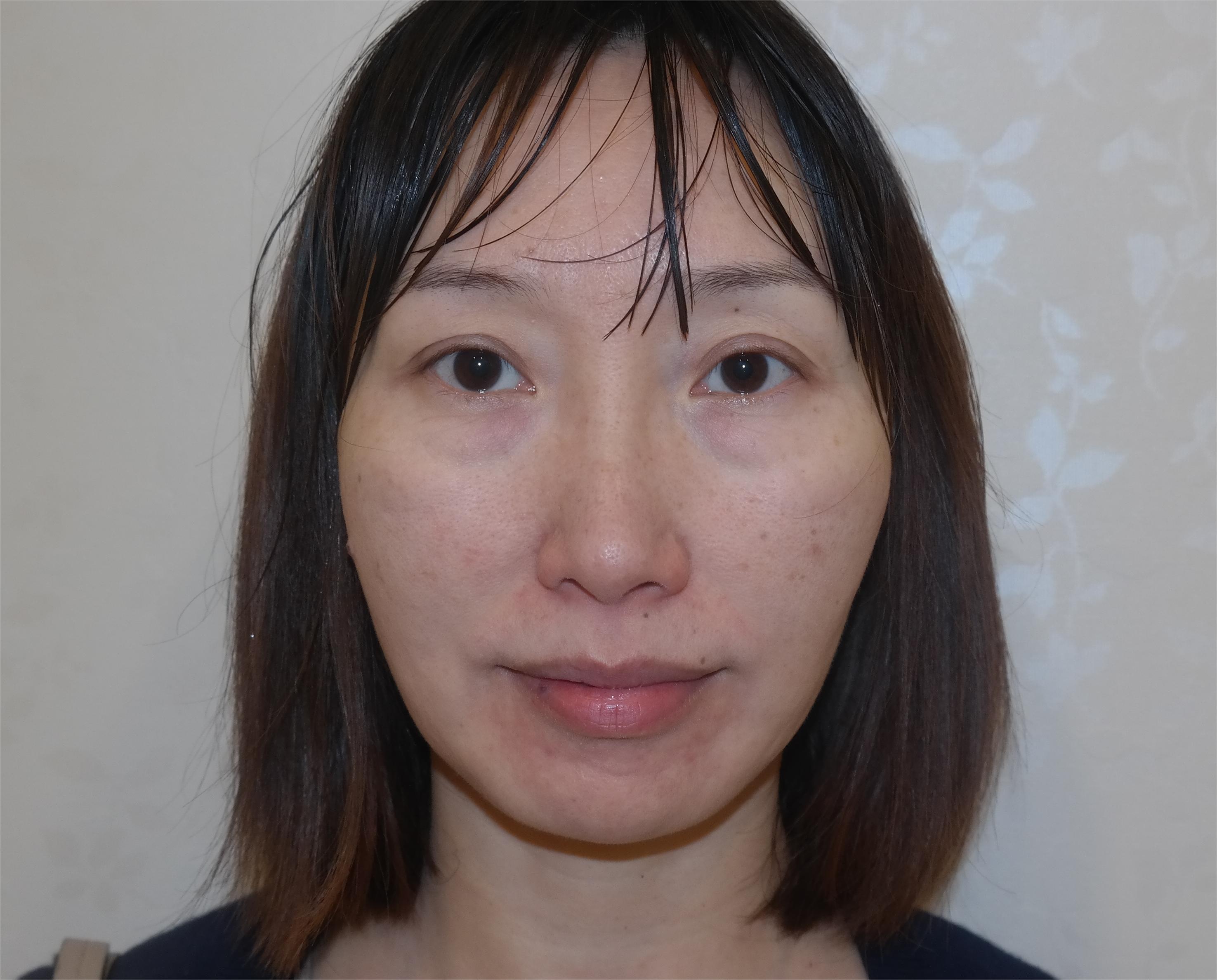 28岁初入职场，从眼袋折磨到美容手术的胜利！