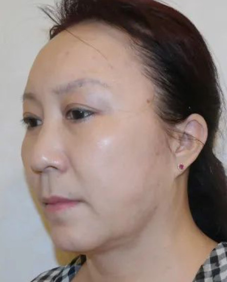 面部提升手术：太惊讶了！5年后她竟然还如此年轻！