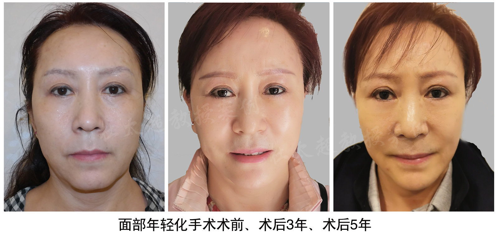 面部提升手术：太惊讶了！5年后她竟然还如此年轻！