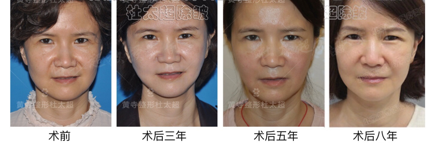 40多岁的那次拉皮太满意了！回顾8年前的相遇。