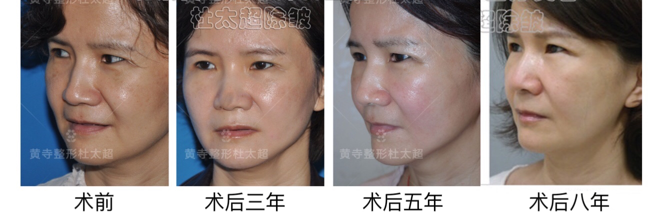 40多岁的那次拉皮太满意了！回顾8年前的相遇。