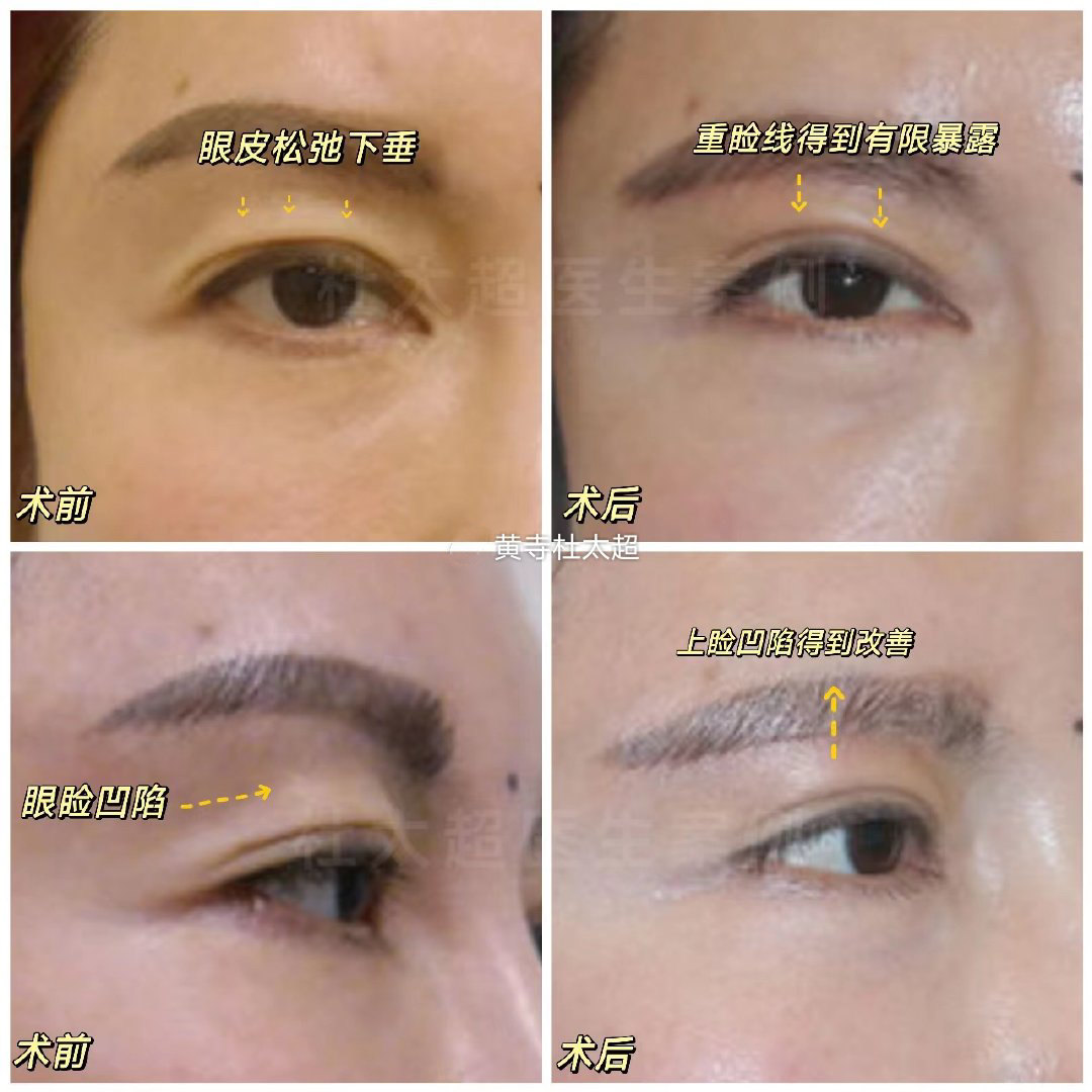 眼睛无神显老，是众多步入40岁大关女士的普遍问题，那么如何预防或者解决这种问题呢？