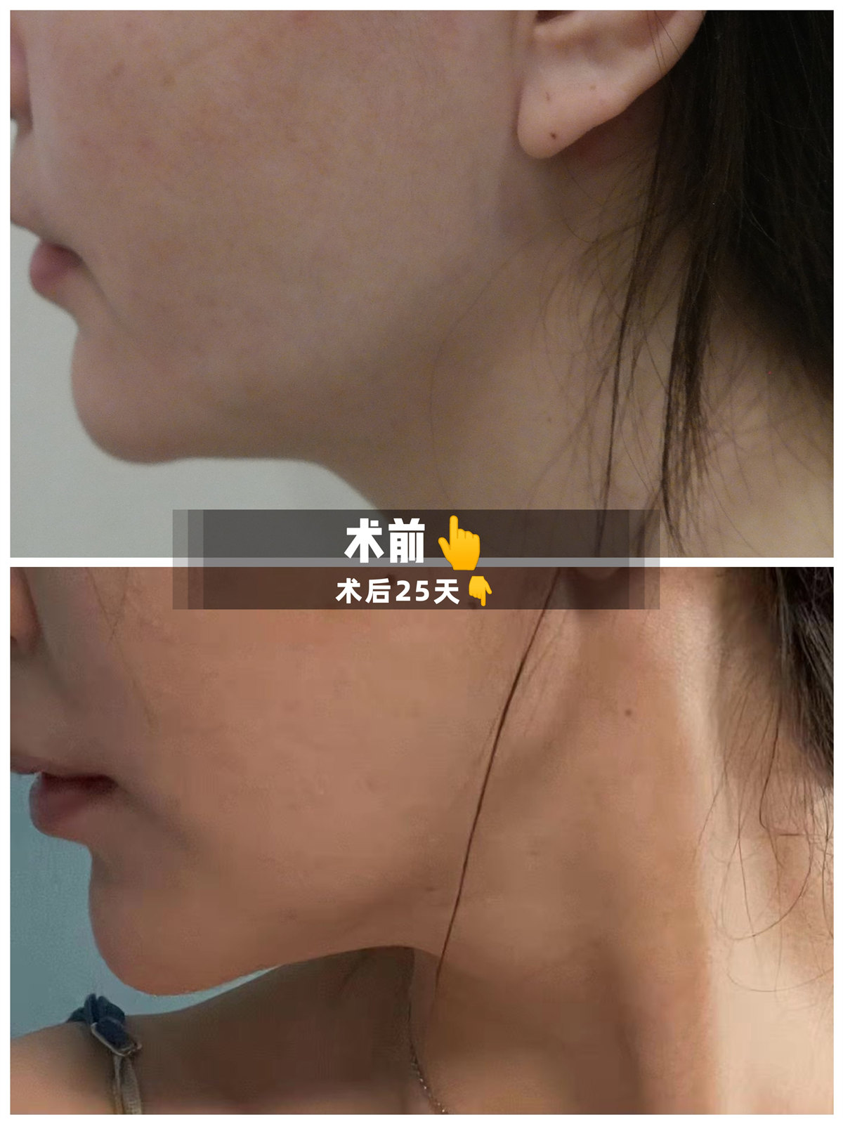 下颌颈部钻石精雕术后25天分享，效果太好了！