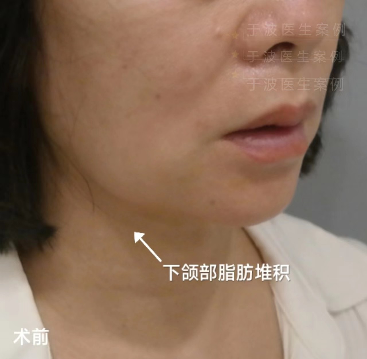 钻石精雕打造少女线术后1个月分享! 钻石精雕打造少女线术后1个月分享!