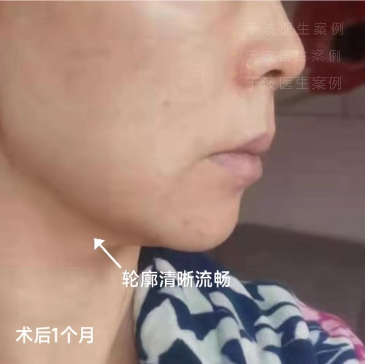 钻石精雕打造少女线术后1个月分享! 钻石精雕打造少女线术后1个月分享!