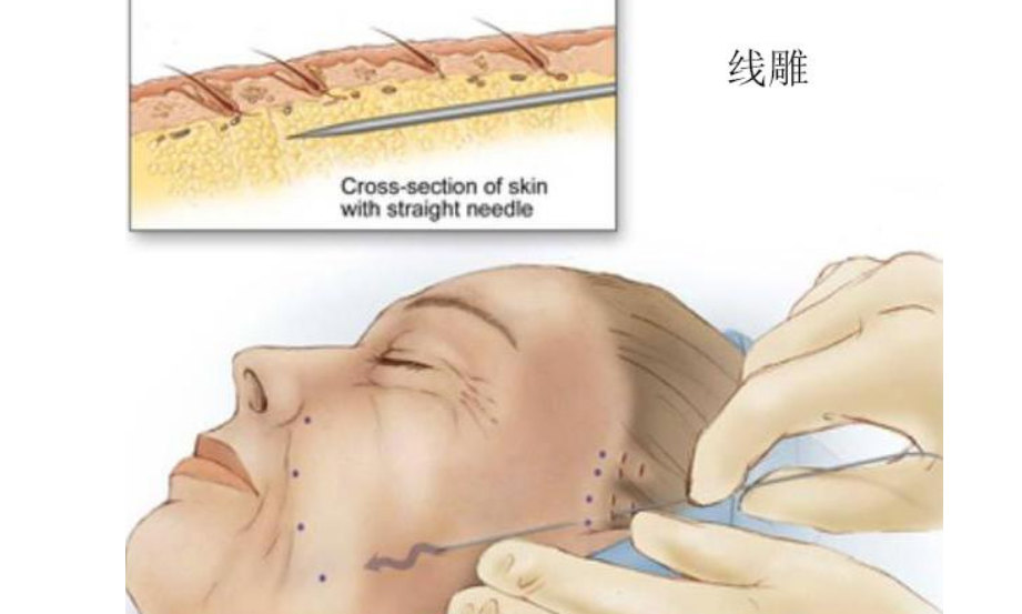 面部提升怎么选？选线雕、热玛吉还是拉皮手术，过来人谈谈经验