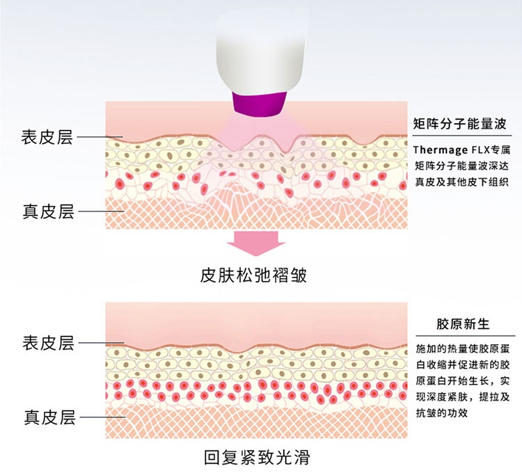 面部提升怎么选？选线雕、热玛吉还是拉皮手术，过来人谈谈经验