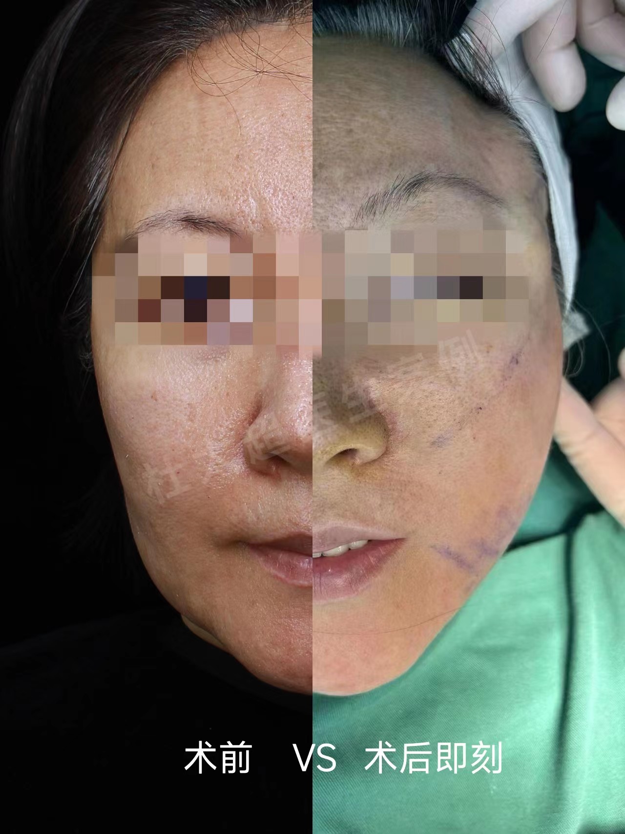 面部提升怎么选？选线雕、热玛吉还是拉皮手术，过来人谈谈经验