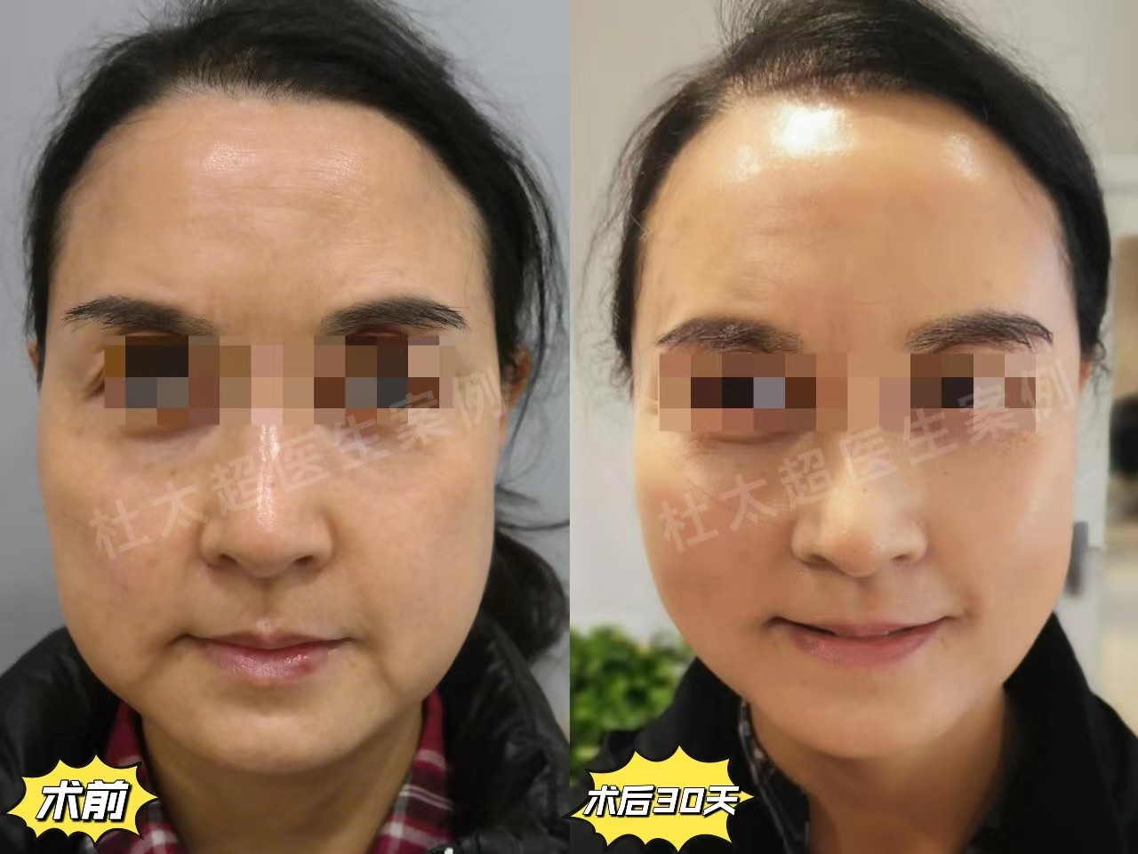 拉皮手术恢复期内成鬼，一个月后越来越美，亲身经历