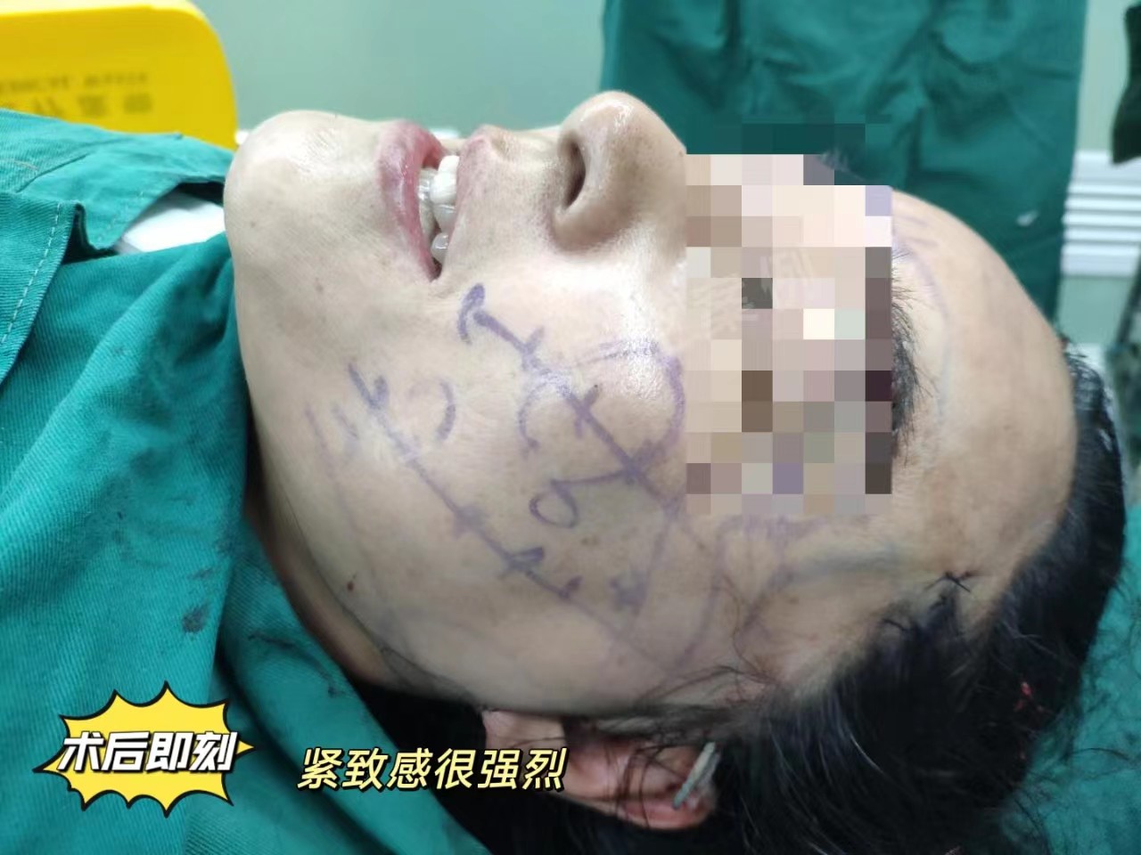 拉皮手术恢复期内成鬼，一个月后越来越美，亲身经历