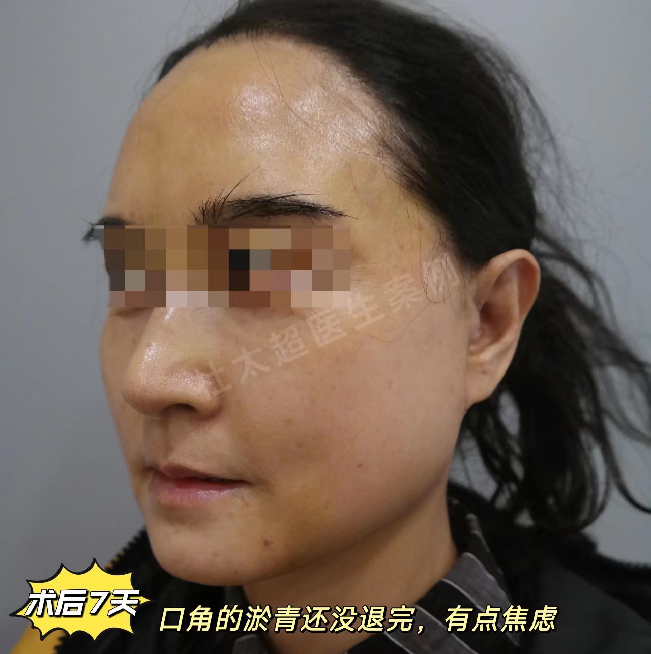 拉皮手术恢复期内成鬼，一个月后越来越美，亲身经历