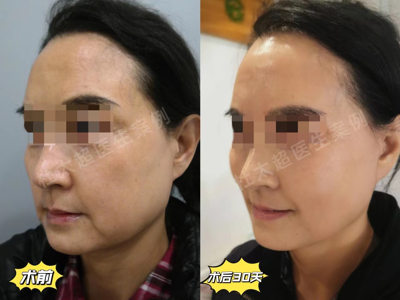 拉皮手术恢复期内成鬼，一个月后越来越美，亲身经历