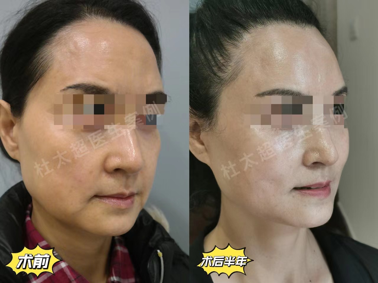 拉皮手术恢复期内成鬼，一个月后越来越美，亲身经历