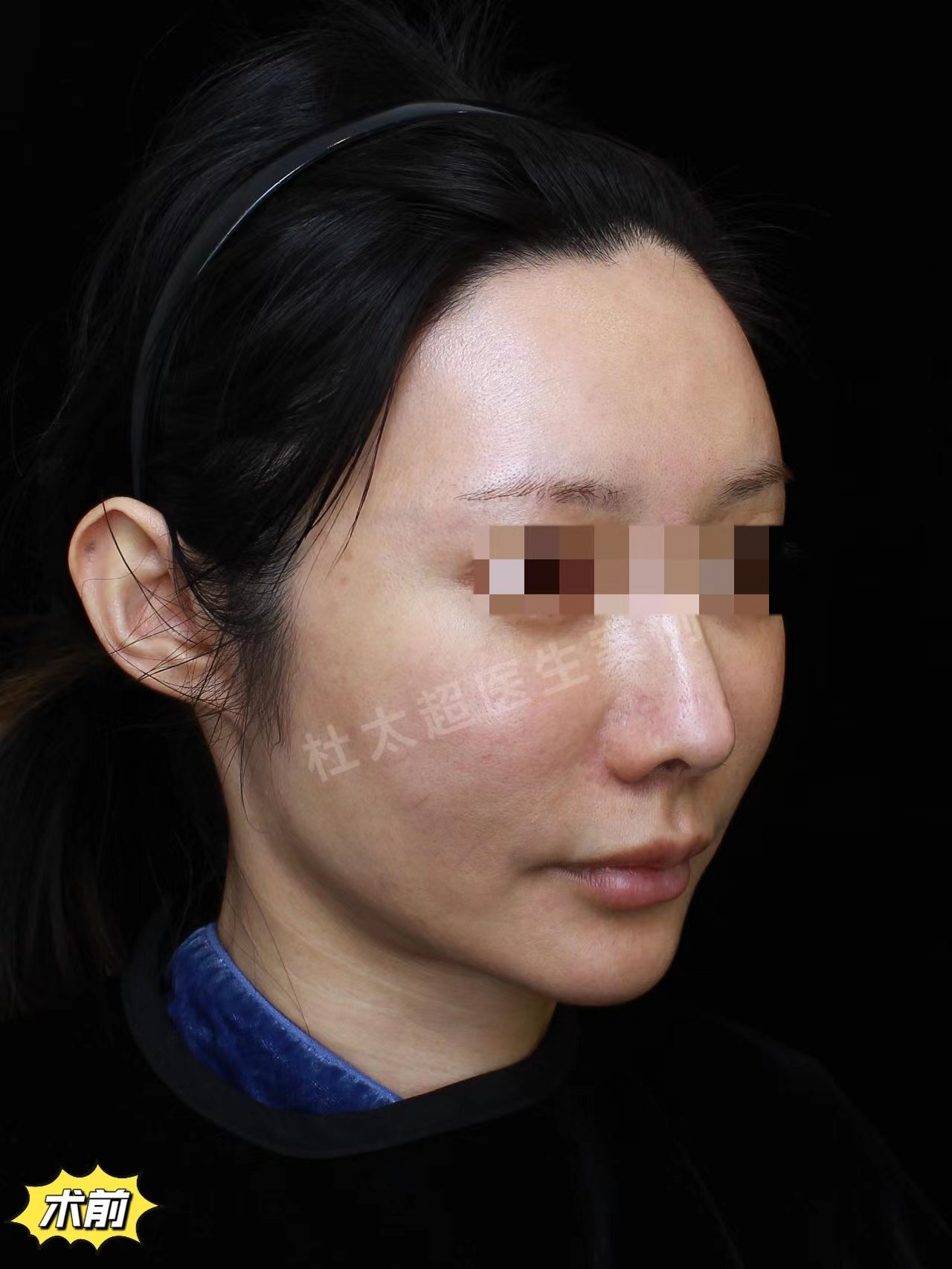 39岁做拉皮手术提升下颌缘，术后4个月肉眼可见的成功了！