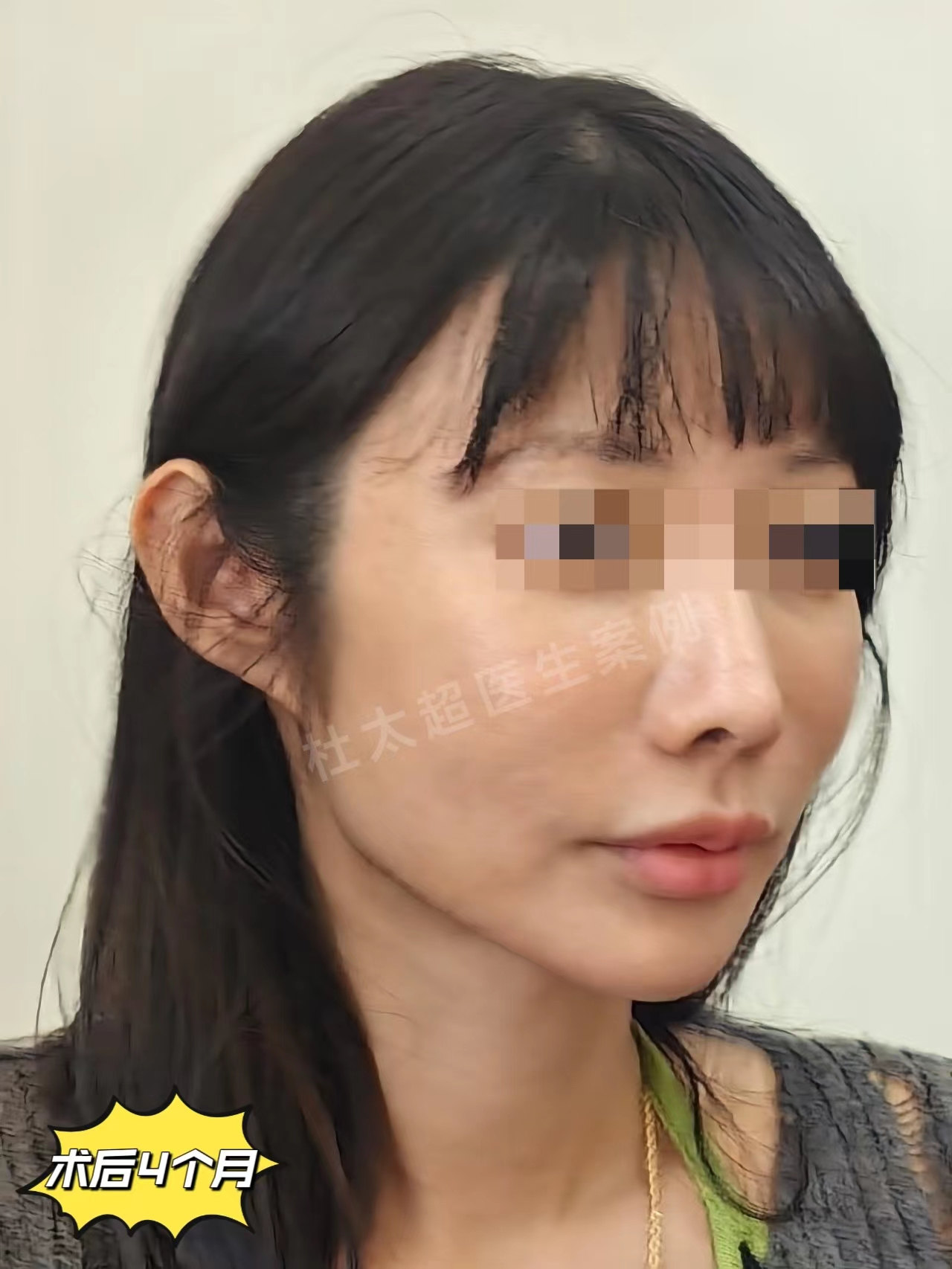 39岁做拉皮手术提升下颌缘，术后4个月肉眼可见的成功了！