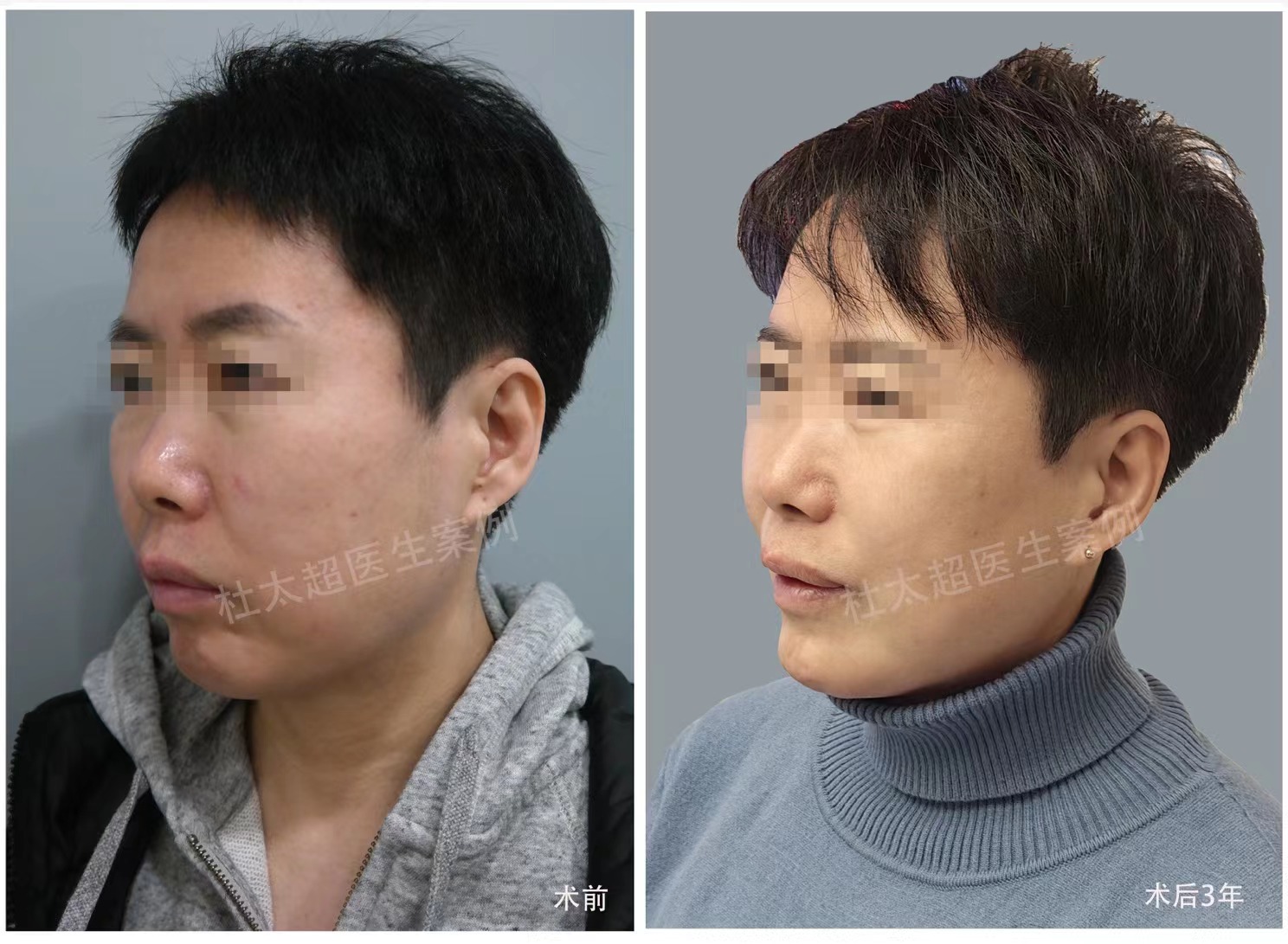 做拉皮手术前，听听过来人的忠告！