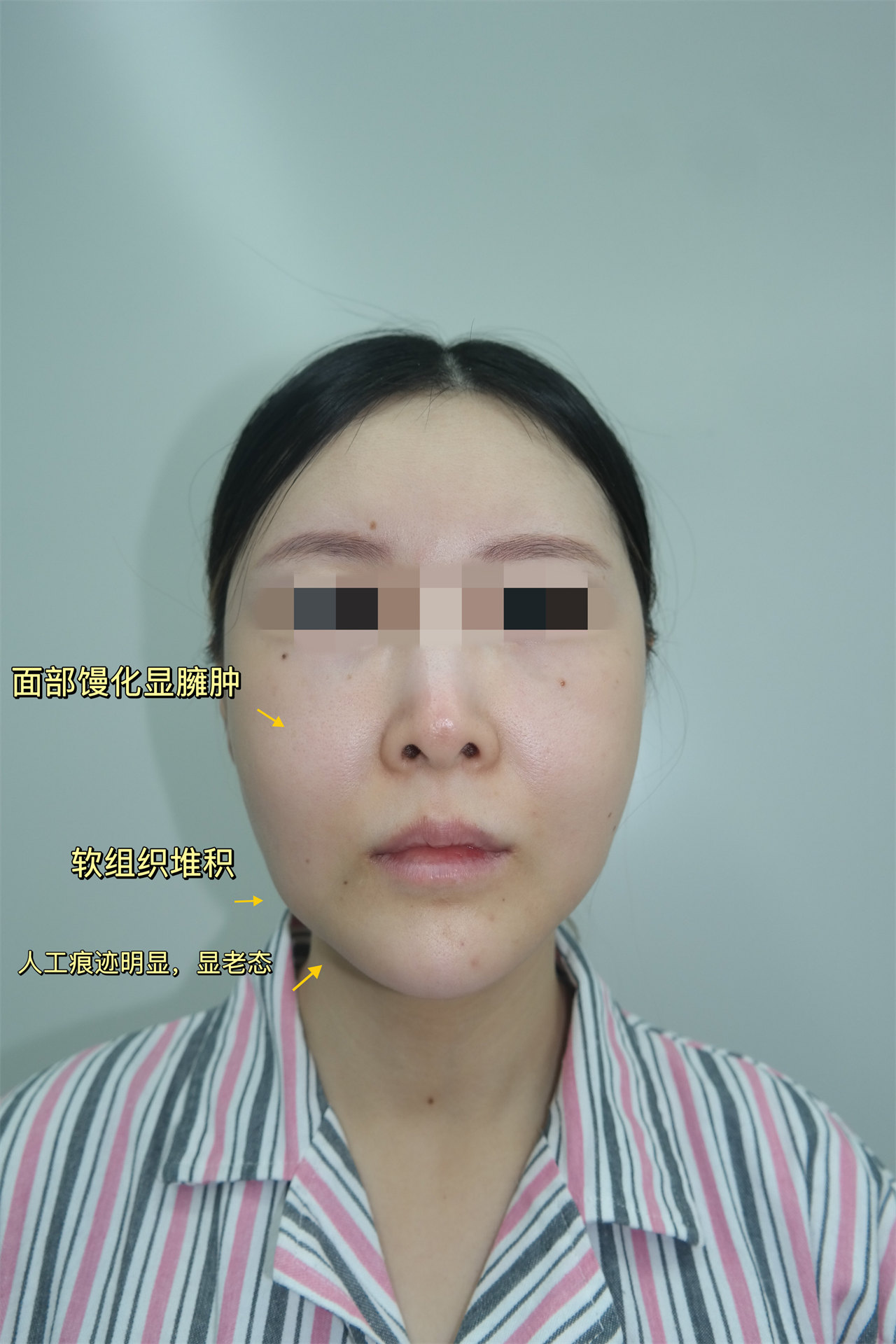 36岁女士，不听劝阻偏要做拉皮手术！结果自己看吧！