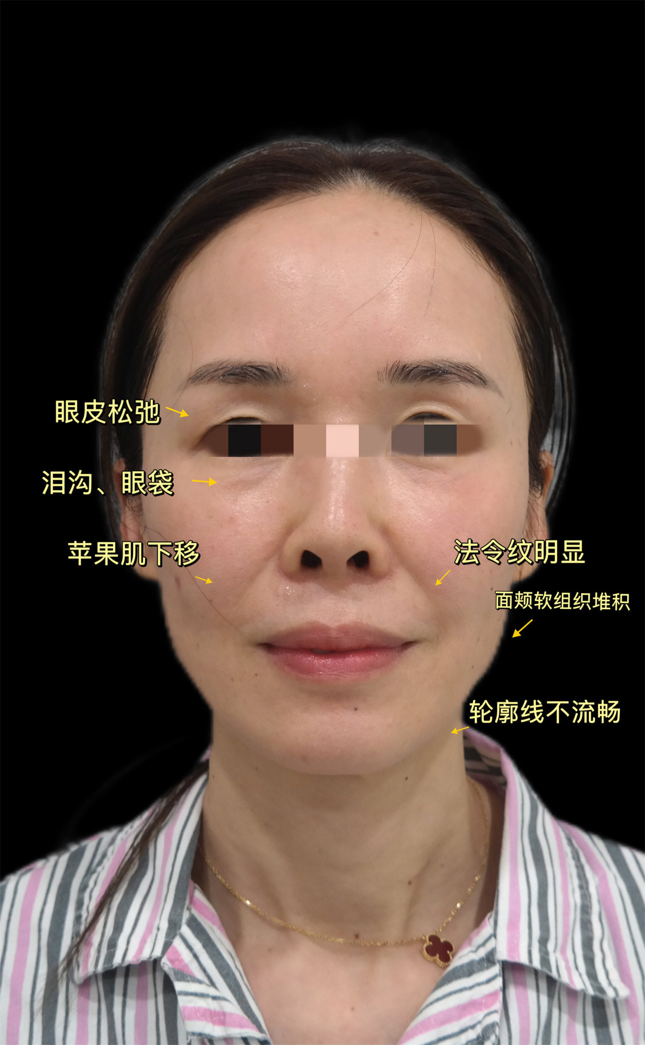 48岁女士，为挽回丈夫的瞩目不惜做拉皮手术！结果太让人意外了！