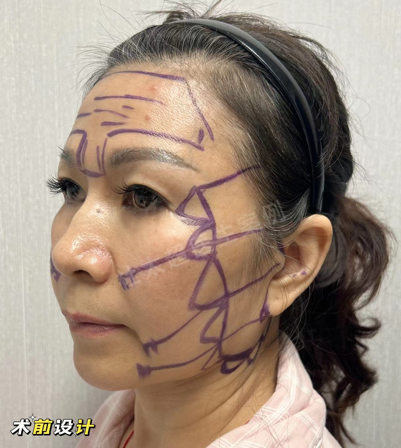 58岁追求青春容颜，不惜做了拉皮手术，没白遭罪！