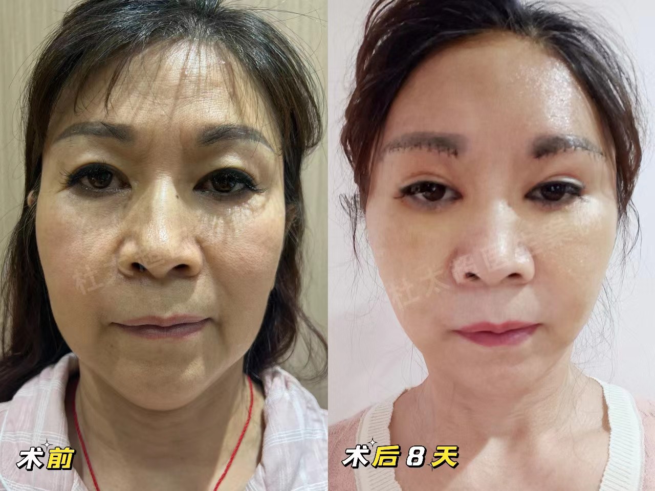 58岁追求青春容颜，不惜做了拉皮手术，没白遭罪！