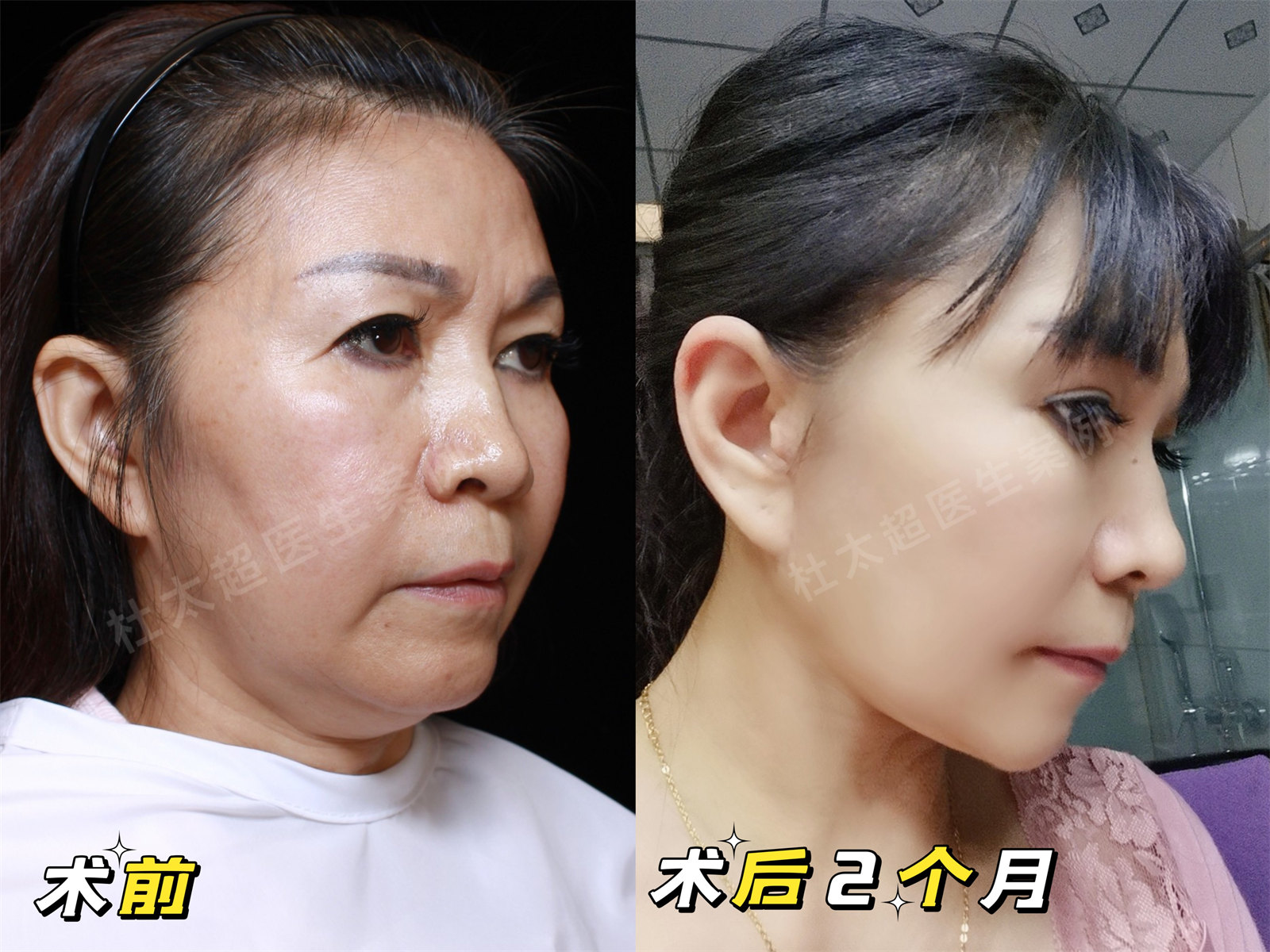 58岁追求青春容颜，不惜做了拉皮手术，没白遭罪！