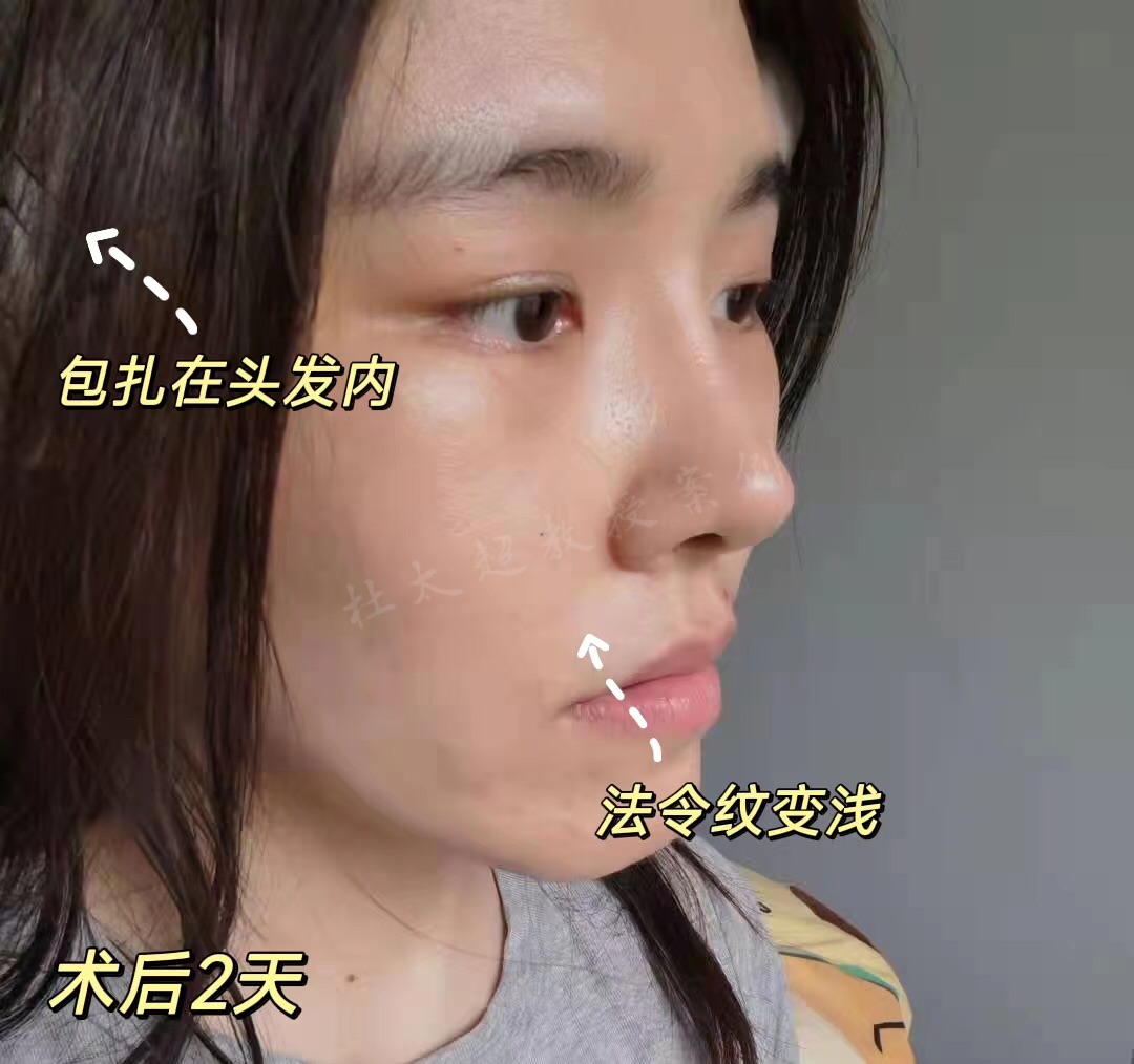 27岁，来自天津，挑战家人禁令成功拉皮！“年轻人”也能回春!