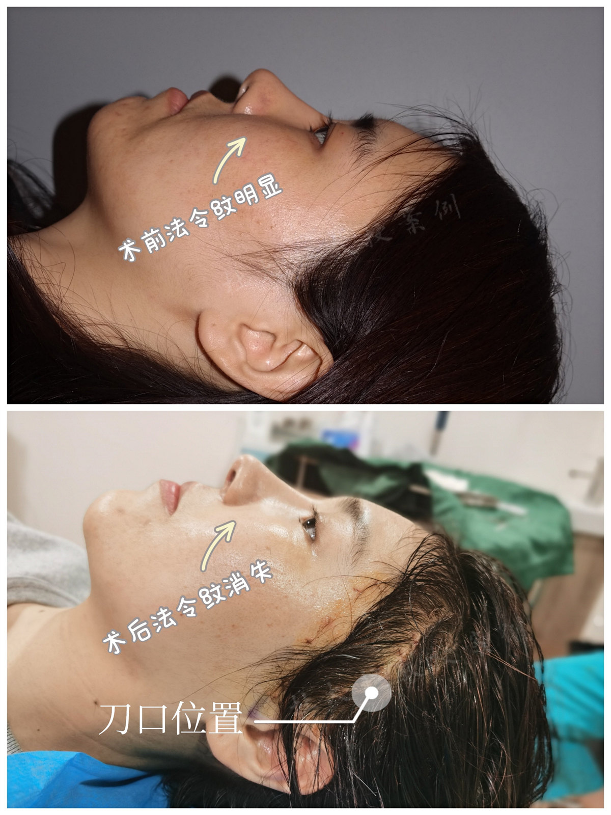 27岁，来自天津，挑战家人禁令成功拉皮！“年轻人”也能回春!