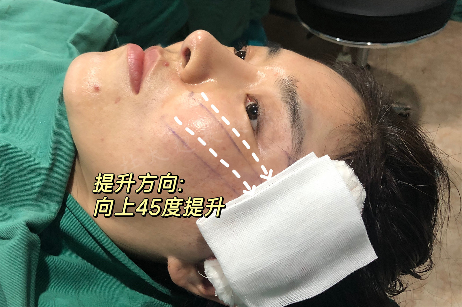 27岁，来自天津，挑战家人禁令成功拉皮！“年轻人”也能回春!