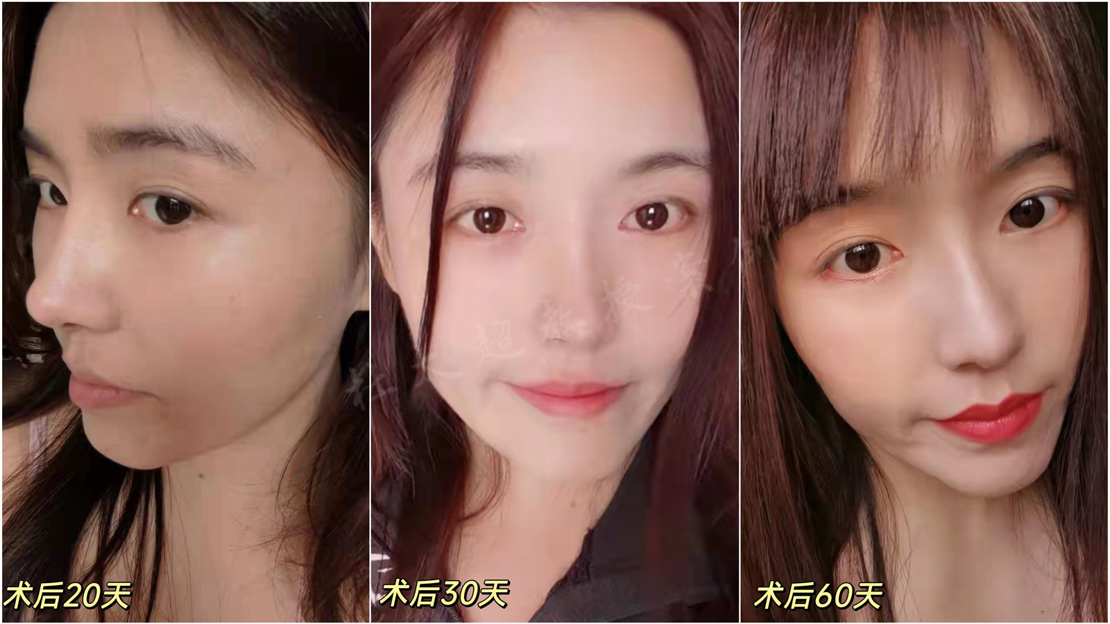 27岁，来自天津，挑战家人禁令成功拉皮！“年轻人”也能回春!