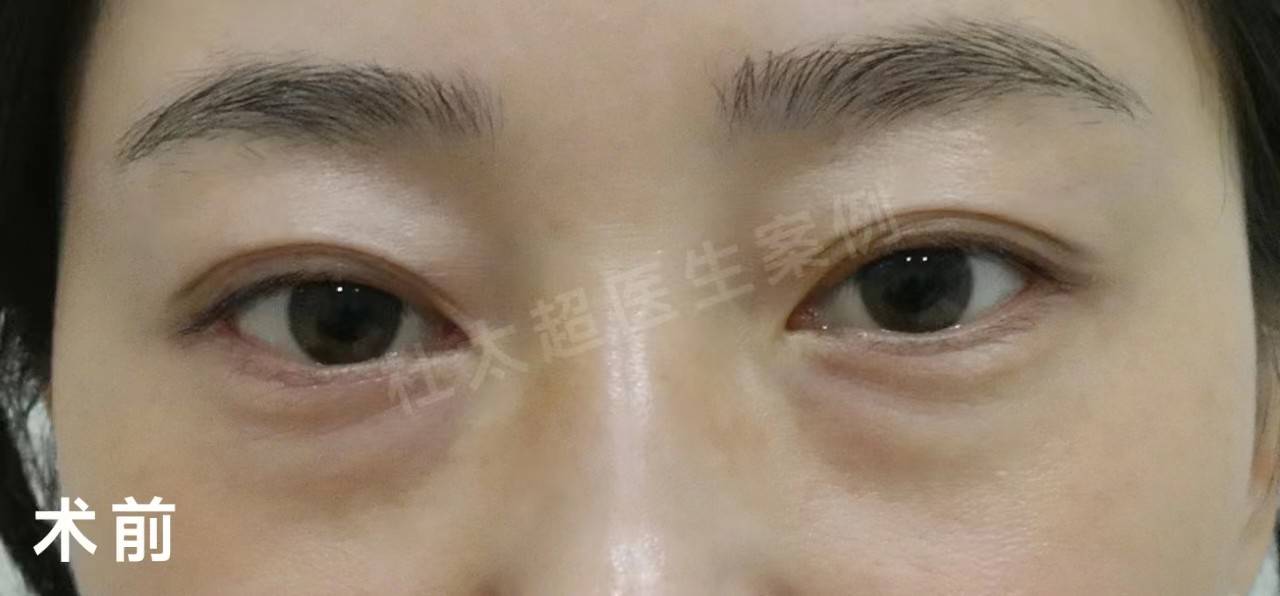 外切去眼袋+重睑修复案例分享，效果很明确！