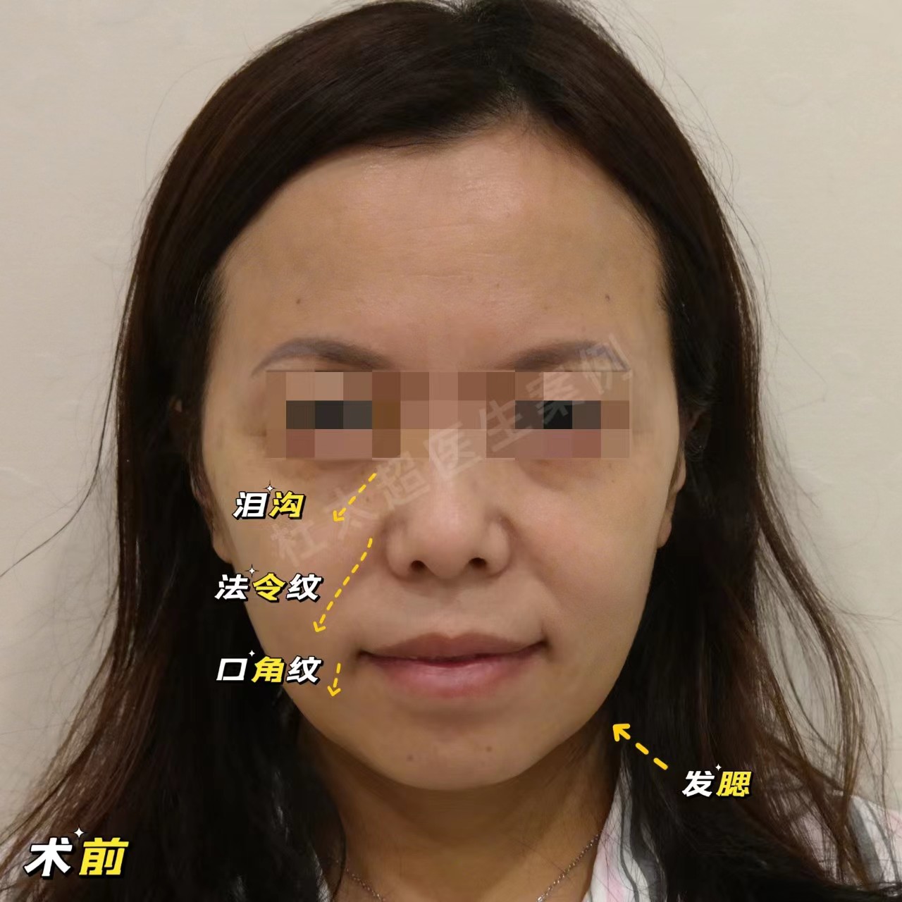 拉皮+去眼袋术后4年，状态比术前还要好