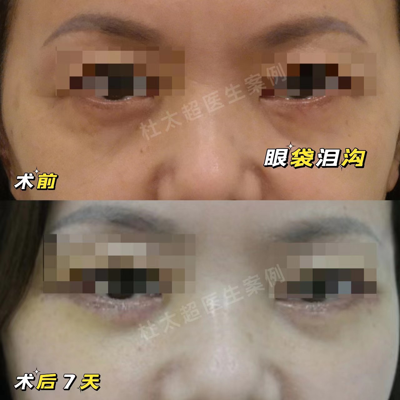 拉皮+去眼袋术后4年，状态比术前还要好