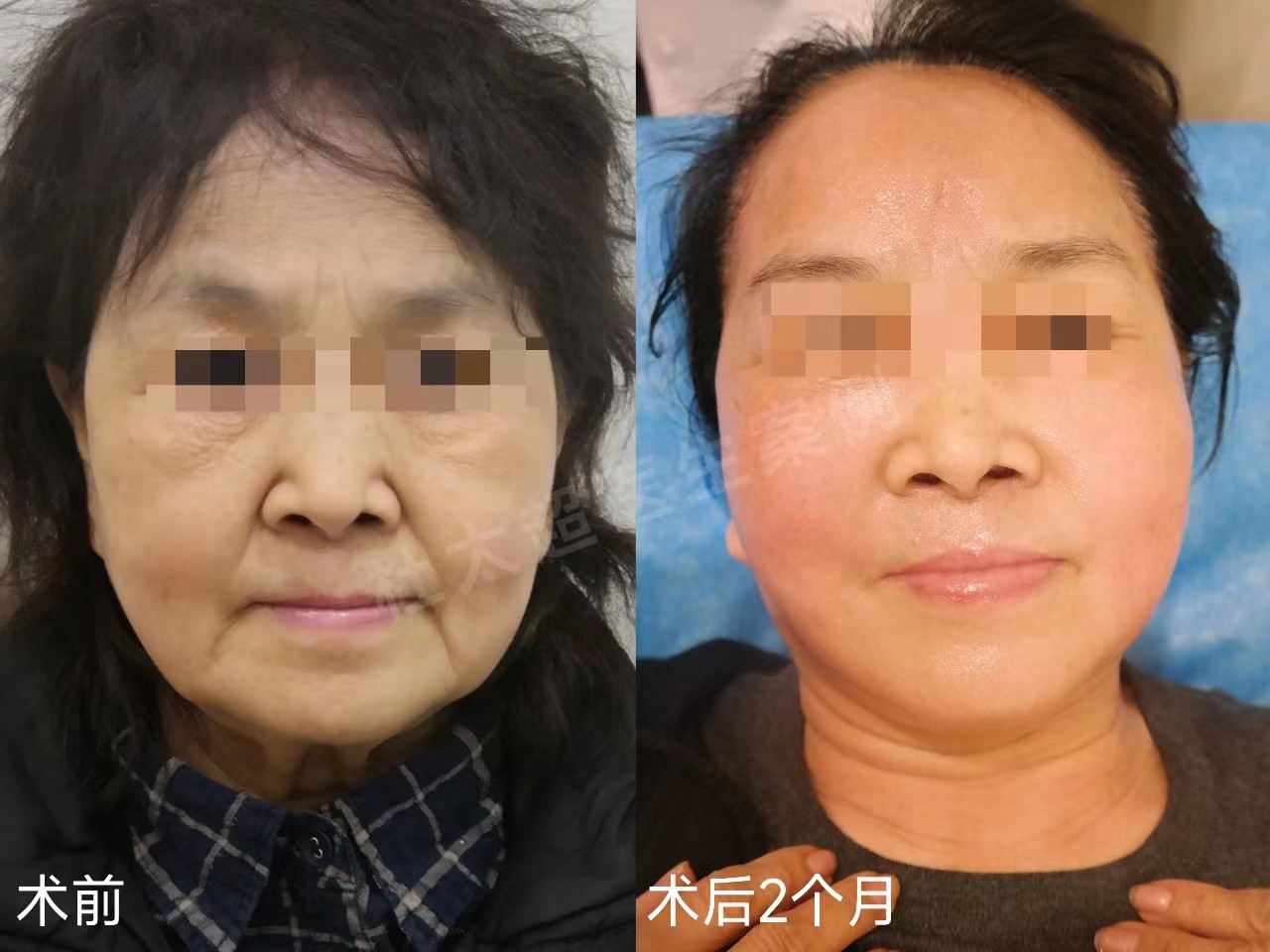 3个真人案例，带你感受，拉皮手术到底能年轻几岁？