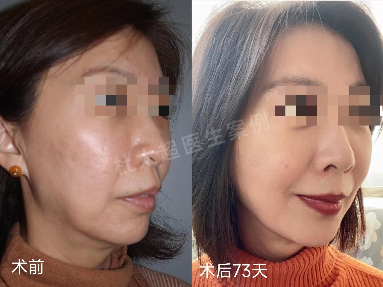 3个真人案例，带你感受，拉皮手术到底能年轻几岁？