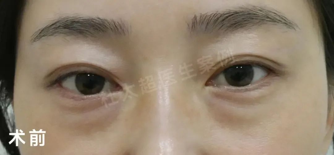 外切去眼袋+重睑修复案例分享,效果很明确! 外切去眼袋+重睑修复案例分享,效果很明确!