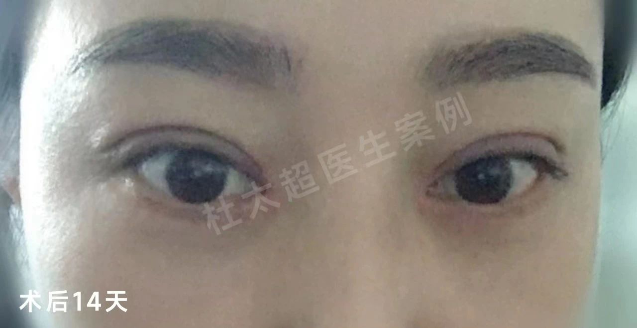 外切去眼袋+重睑修复案例分享,效果很明确! 外切去眼袋+重睑修复案例分享,效果很明确!