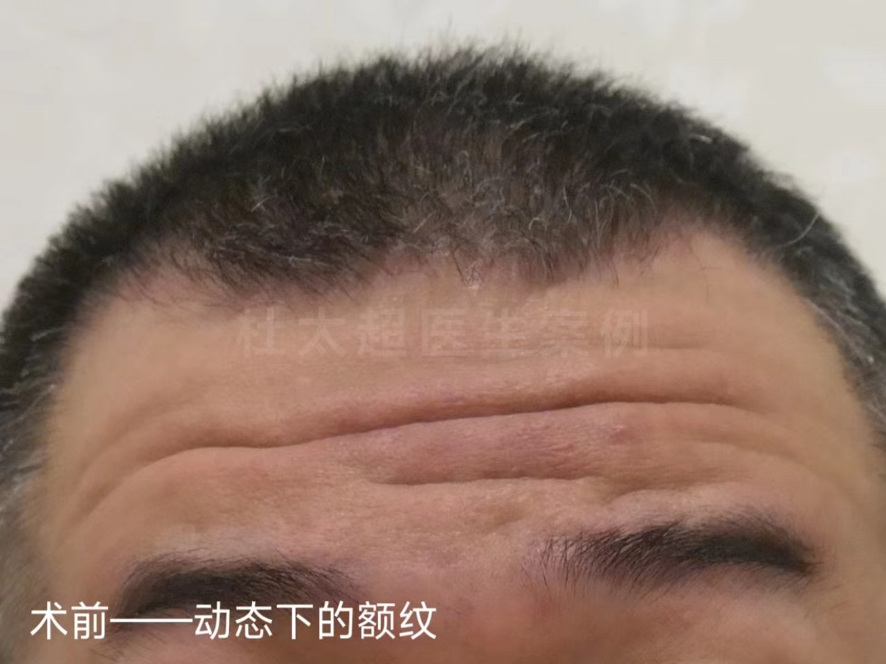 男士额纹深邃，不接受大切口除皱，这样做有效改善！