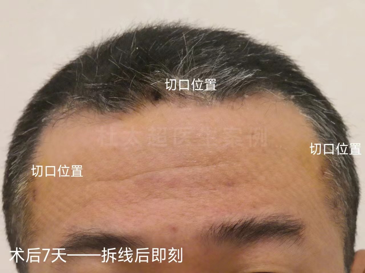 男士额纹深邃，不接受大切口除皱，这样做有效改善！