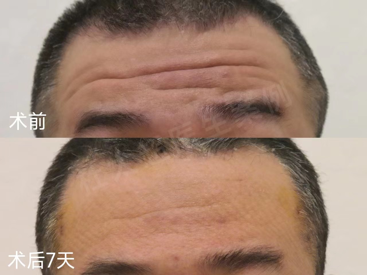 男士额纹深邃，不接受大切口除皱，这样做有效改善！