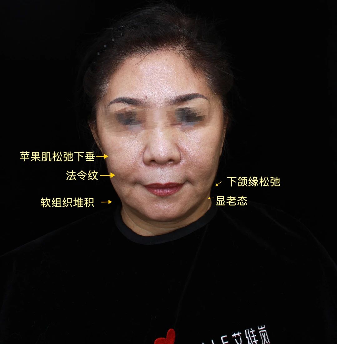 她说：过去我曾尝试过拉皮手术，但结果却留下了难以磨灭痕迹！