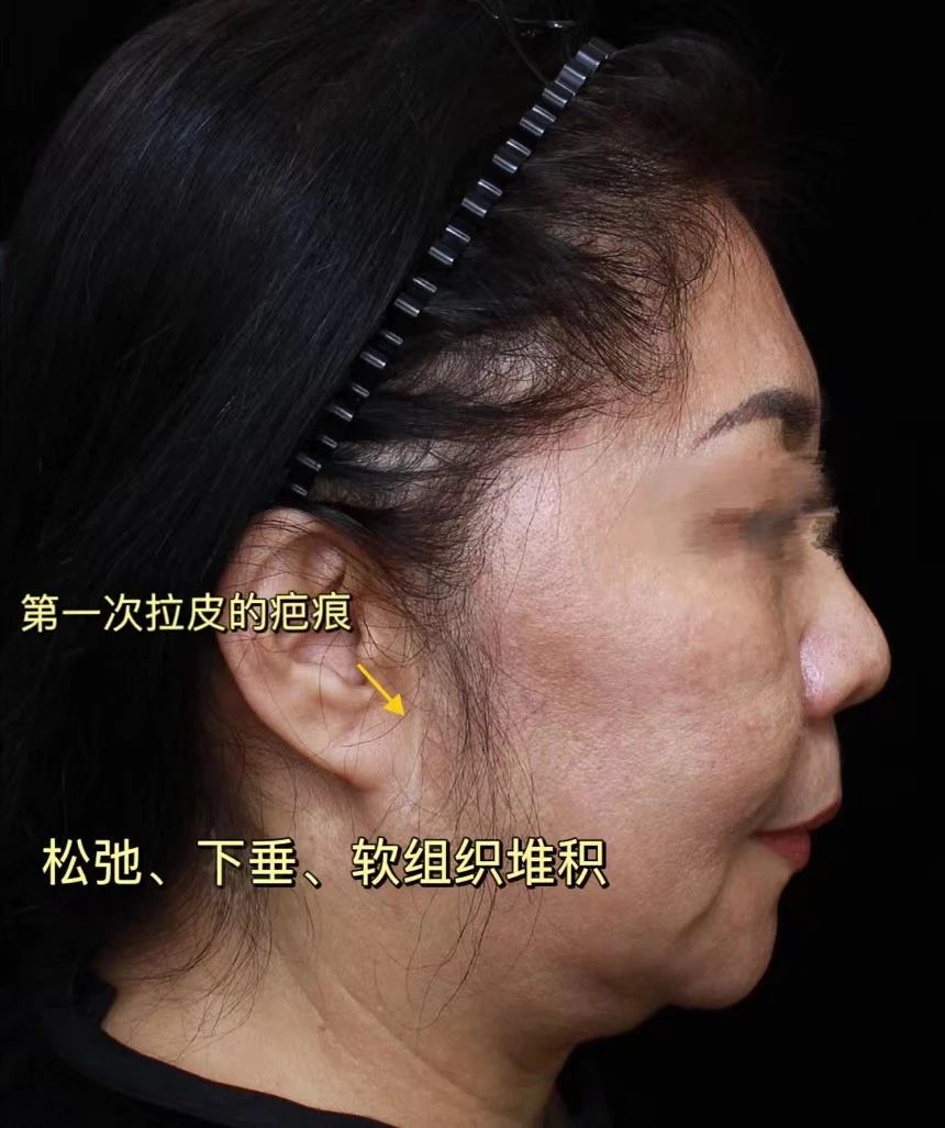 她说：过去我曾尝试过拉皮手术，但结果却留下了难以磨灭痕迹！