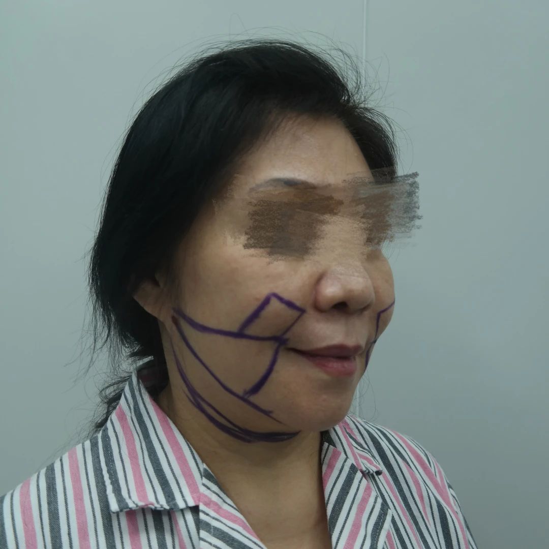 她说：过去我曾尝试过拉皮手术，但结果却留下了难以磨灭痕迹！