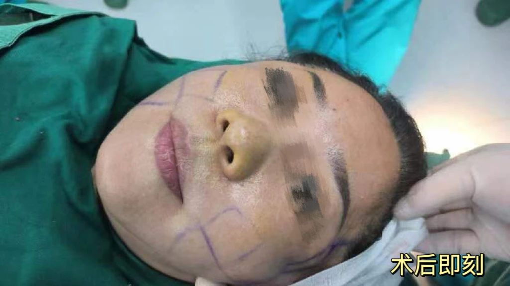 她说：过去我曾尝试过拉皮手术，但结果却留下了难以磨灭痕迹！